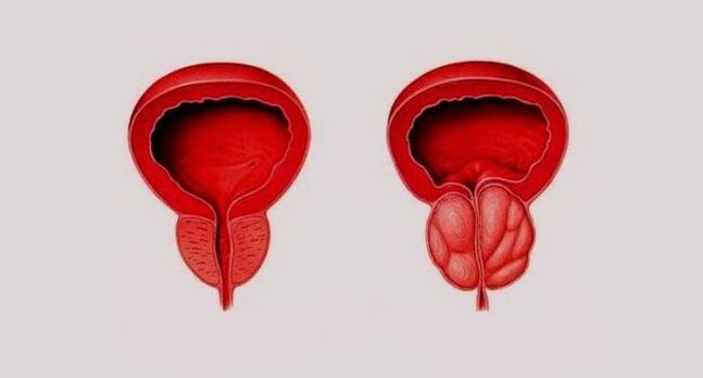 Gesunde Prostata (links) und entzündet durch Prostatitis (rechts)