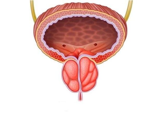 Entzündung der Prostata bei Männern