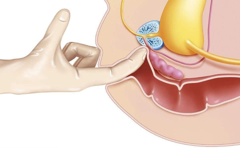 Prostatamassage