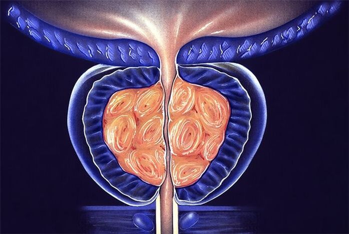 Entzündung der Prostata bei Männern