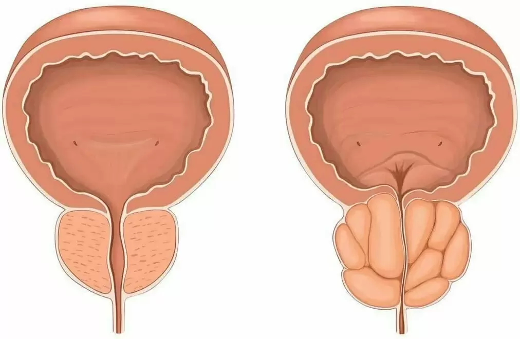 Normale Prostata und schmerzende Prostata