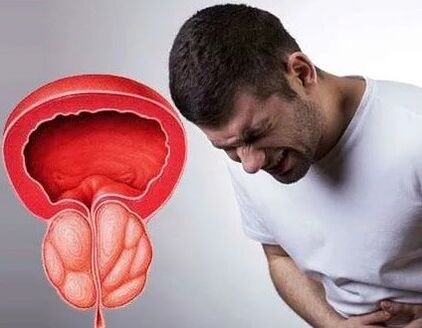 Symptome einer chronischen Prostatitis bei Männern